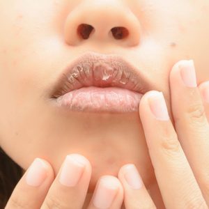 Chapped lips touched by fingers, close-up, surrounded by facial skin.