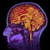 5 People Whose Brain Injuries Gave Them New Abilities