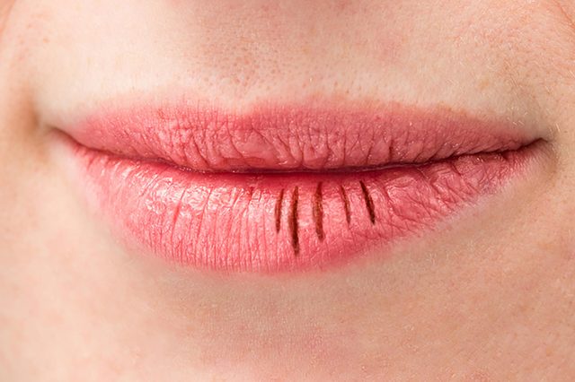 chapped-lips