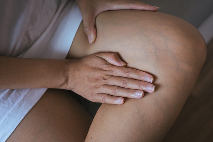 Varicose veins on the womans legs,close up