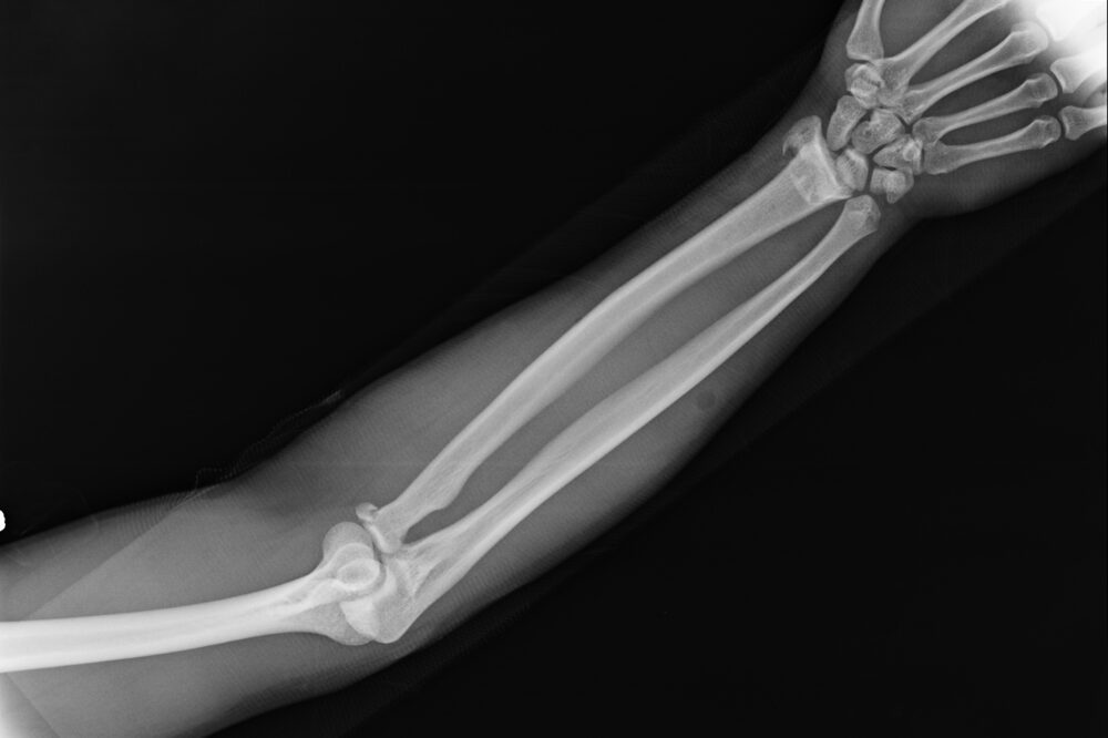 X-ray view of elbow