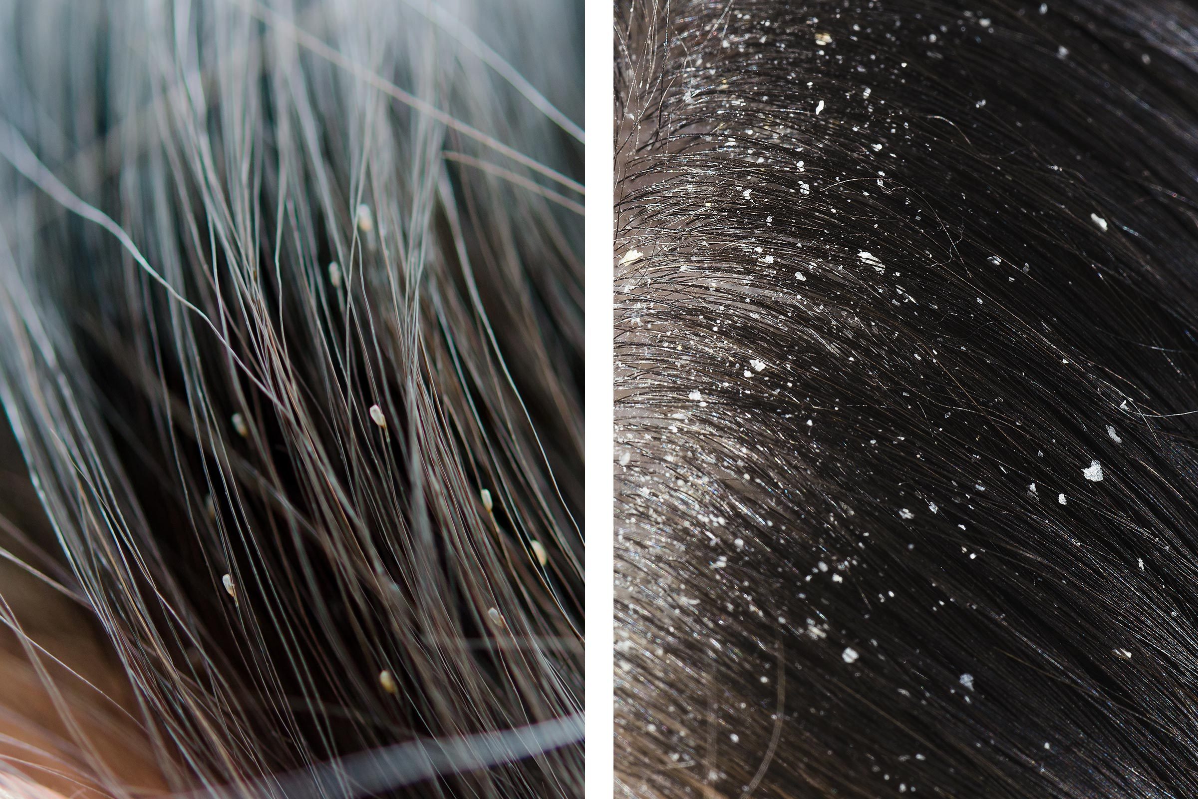 lice dandruff