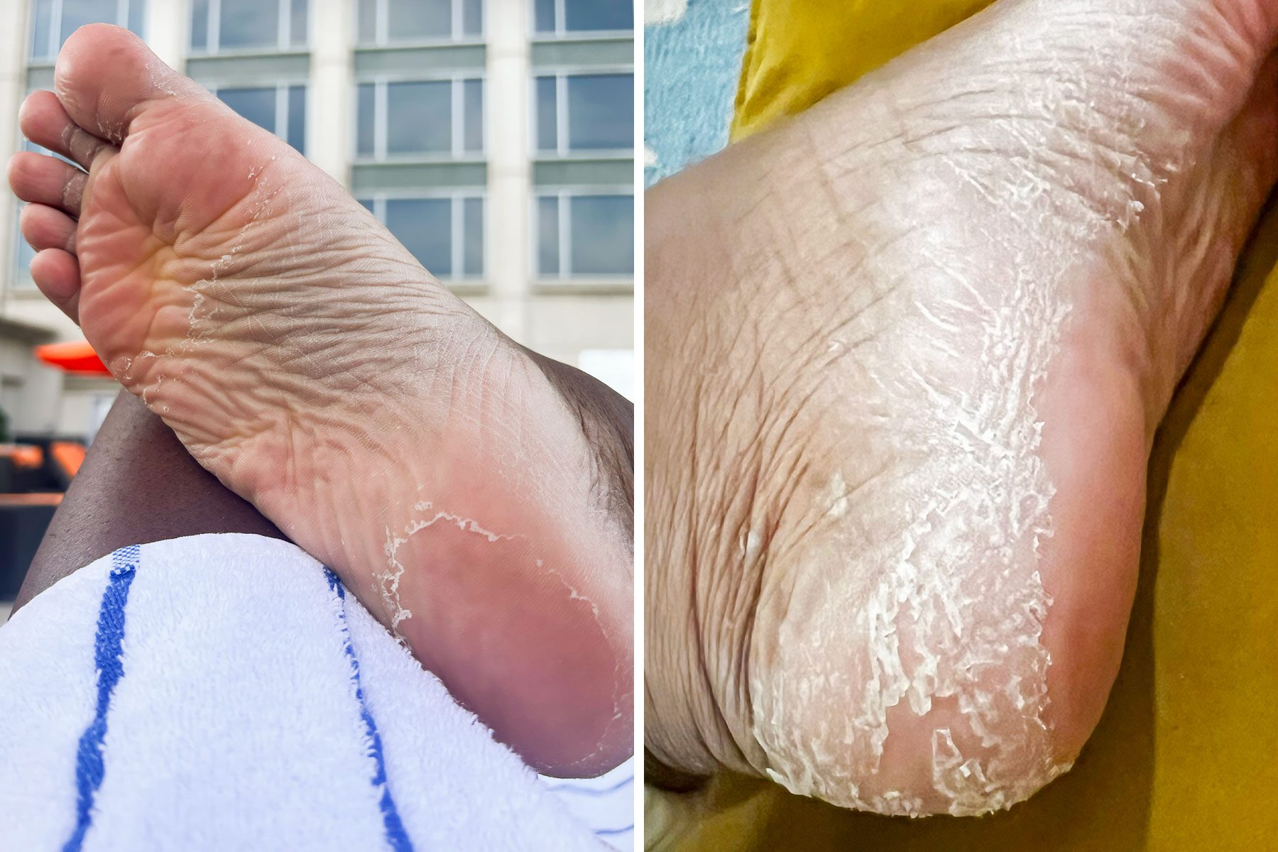 Baby Foot Peel