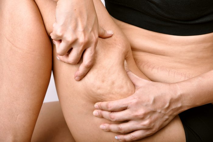Cellulite mark problem on leg, Fat woman with excessive belly pinching thigh skin, Overweight body test.